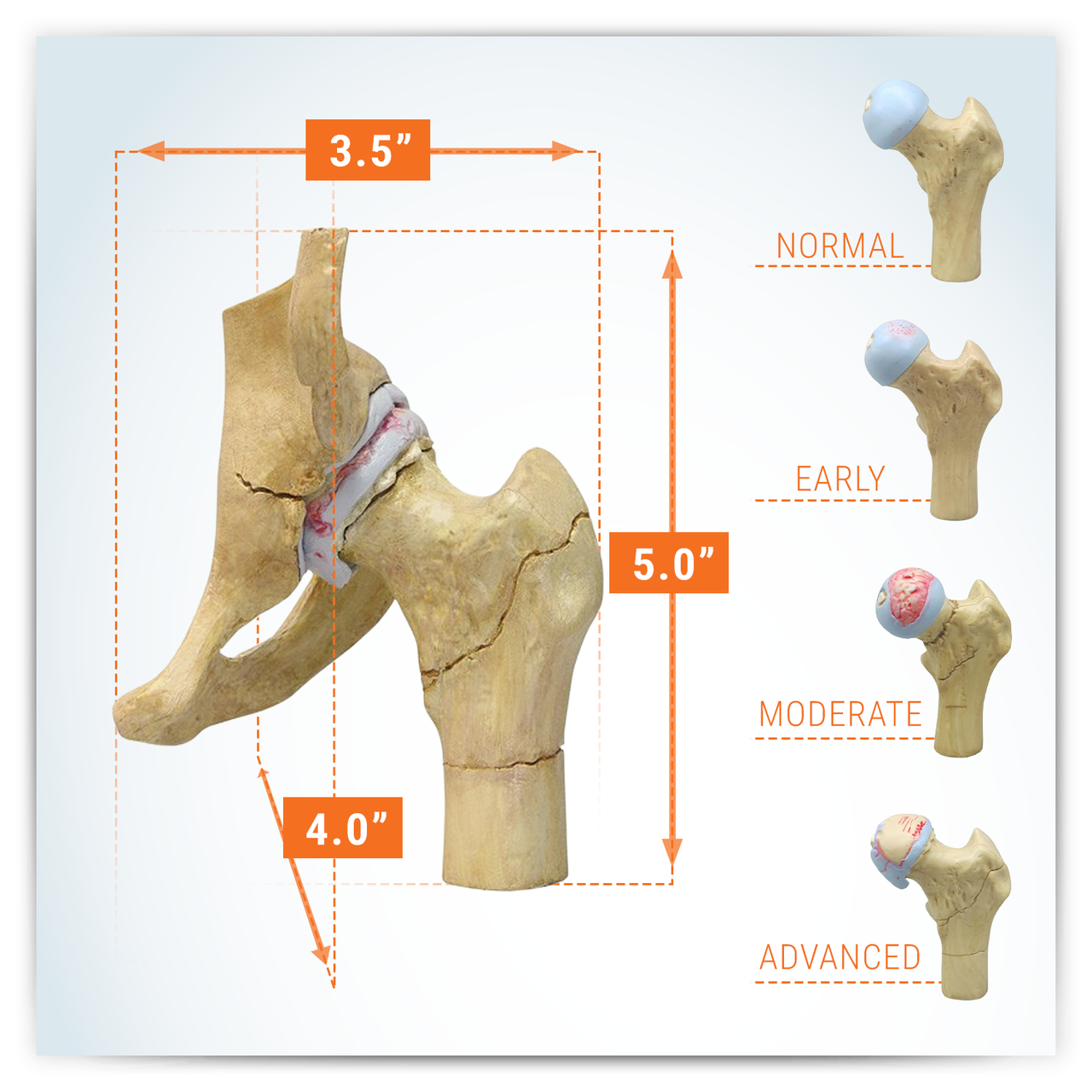 4-Stage Arthritic Hip Anatomy Model