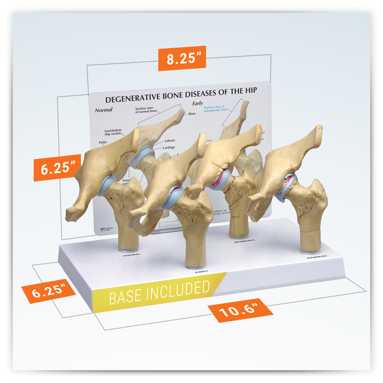 4-Stage Arthritic Hip Anatomy Model