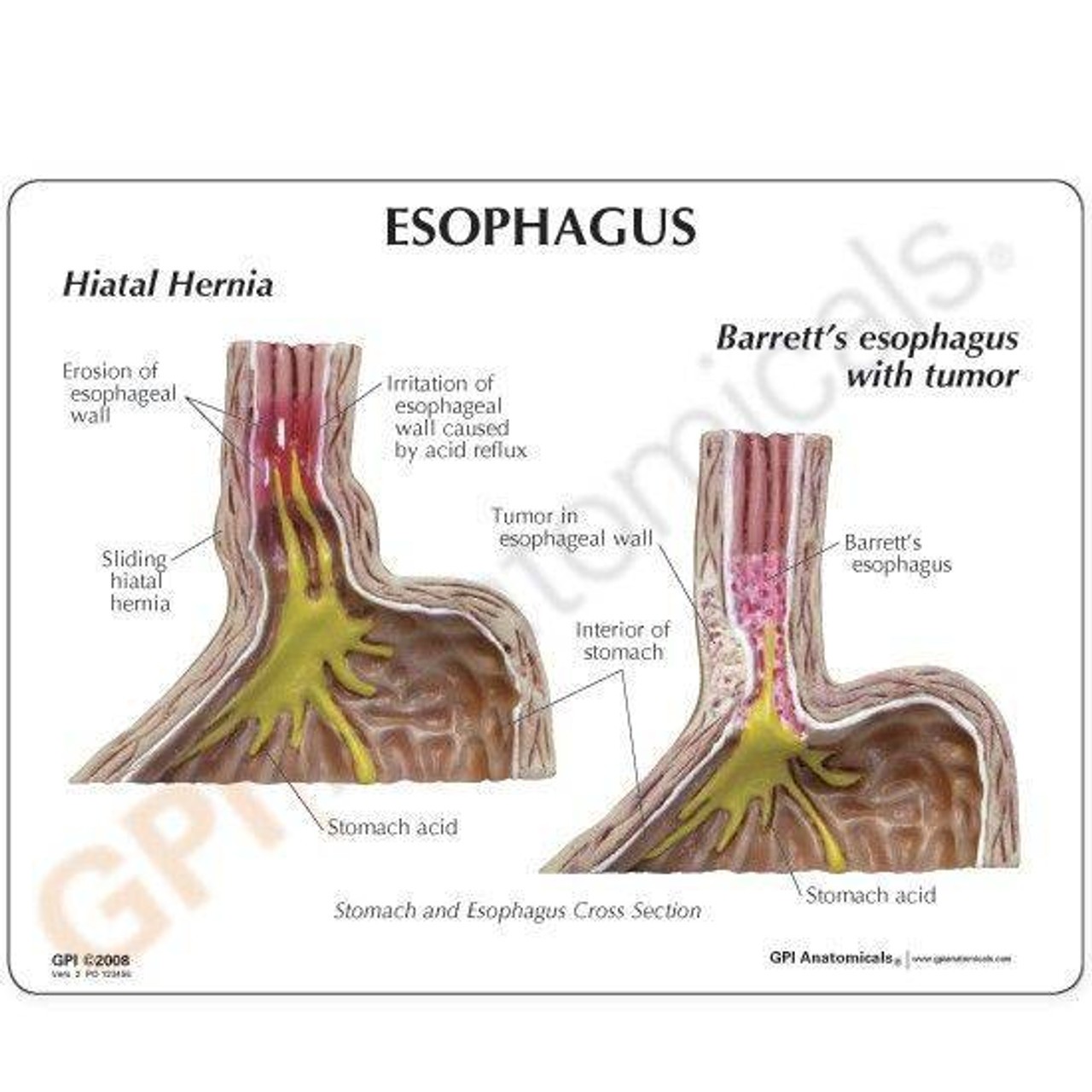 Gastroesophageal Reflux Disease Anatomy Model Gerd