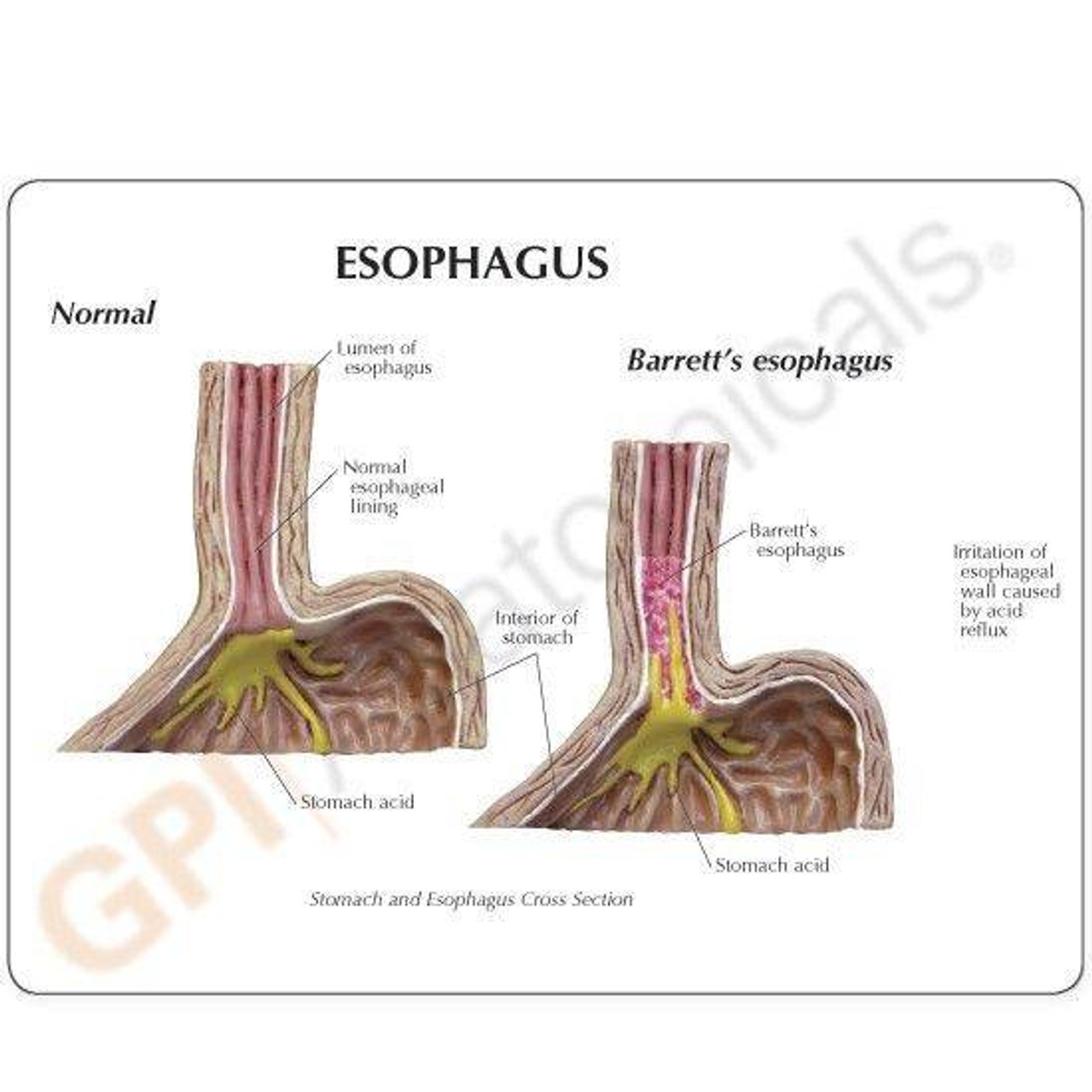 Gastroesophageal Reflux Disease Anatomy Model Gerd