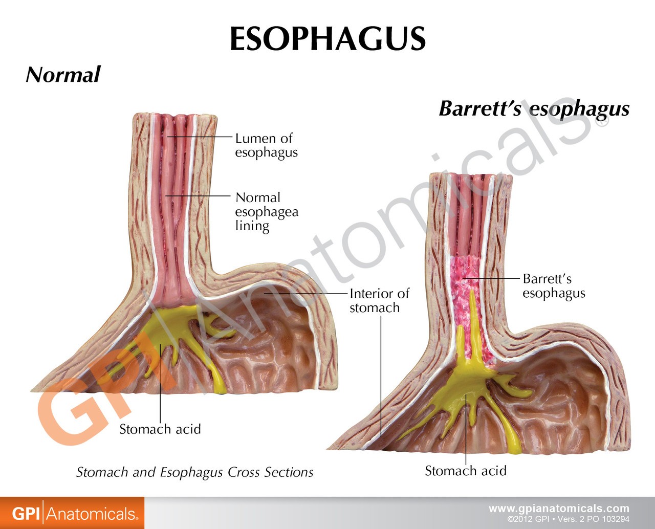 Gastroesophageal Reflux Disease Anatomy Model Gerd