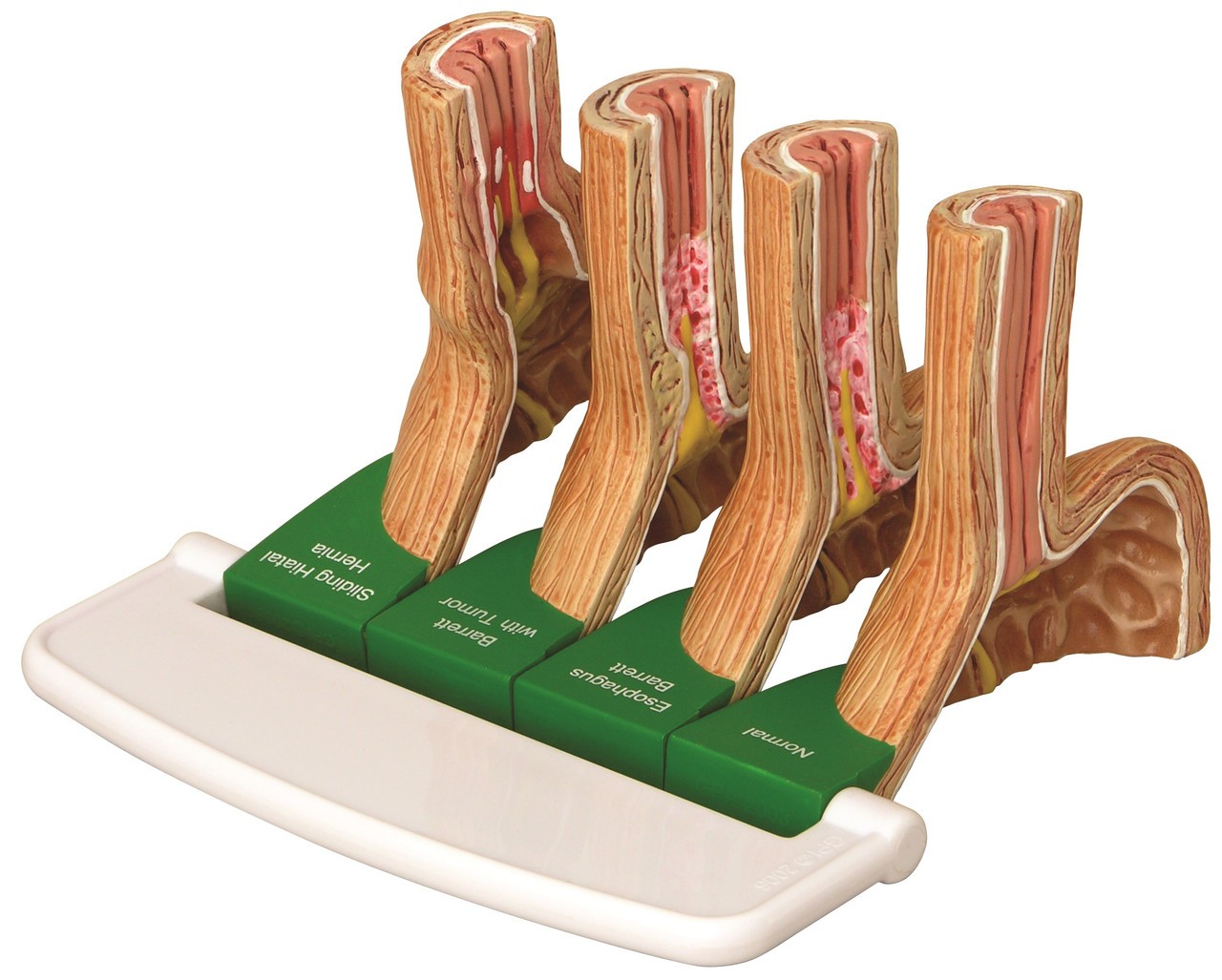 Gastroesophageal Reflux Disease Anatomy Model Gerd
