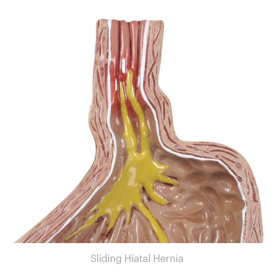 Gastroesophageal Reflux Disease Anatomy Model Gerd