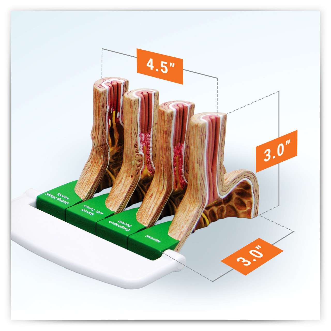 Gastroesophageal Reflux Disease Anatomy Model Gerd