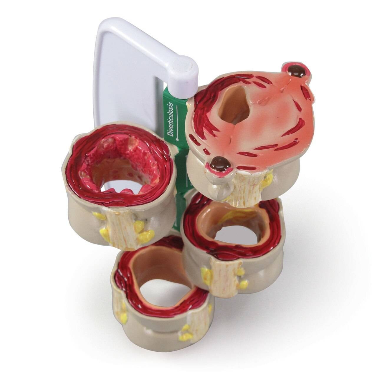 4-Piece Colon With Pathologies Anatomy Model