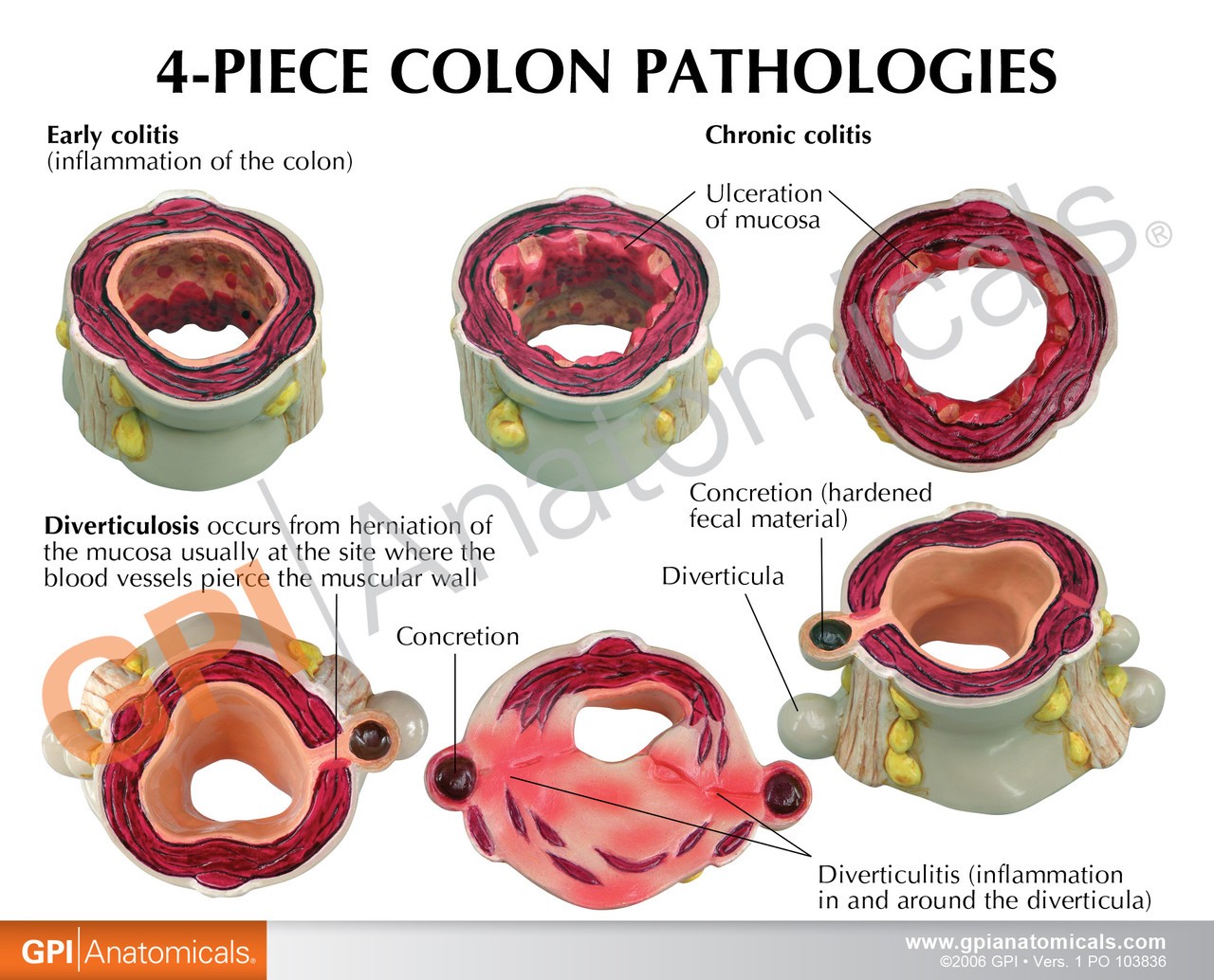 4-Piece Colon With Pathologies Anatomy Model