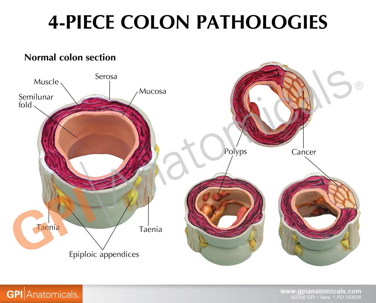 4-Piece Colon With Pathologies Anatomy Model