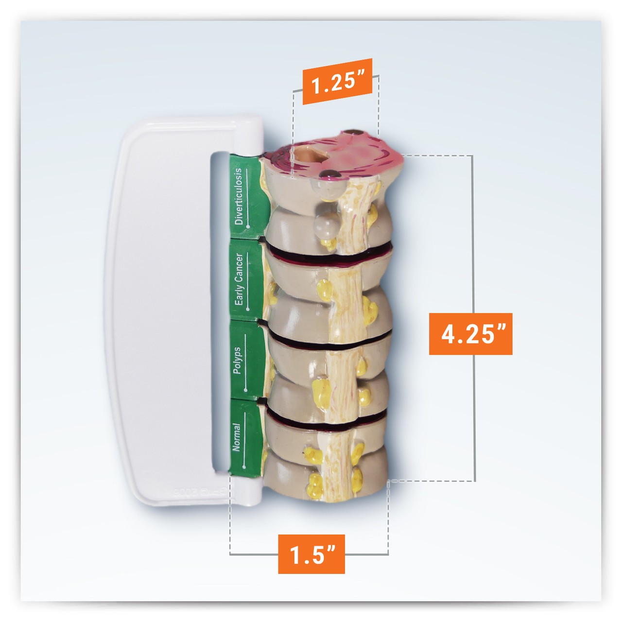 4-Piece Colon With Pathologies Anatomy Model