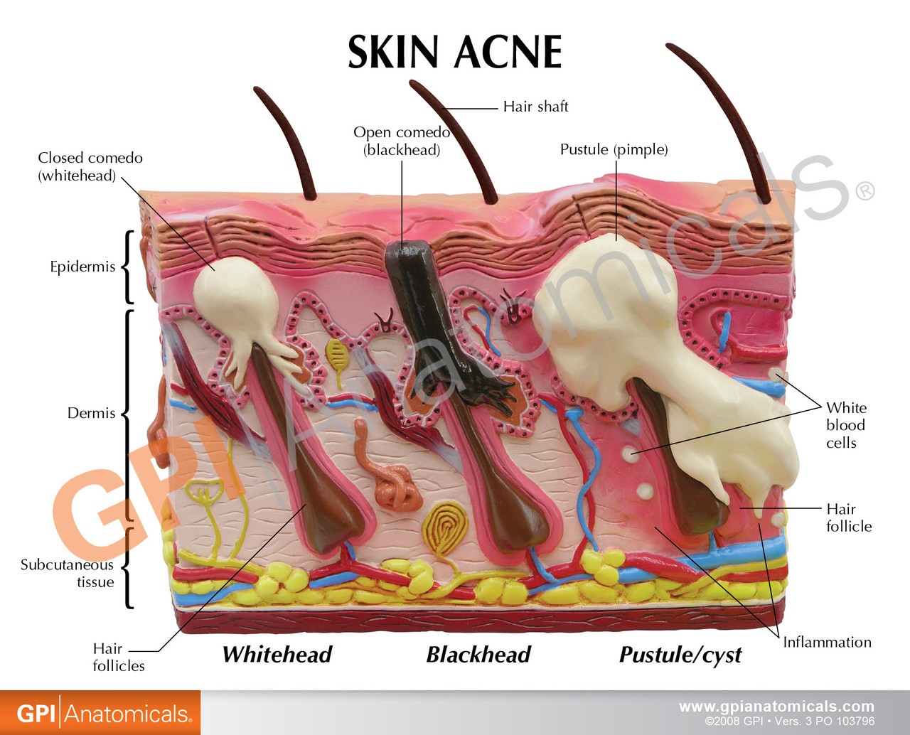 Skin Normal/Acne Anatomy Model