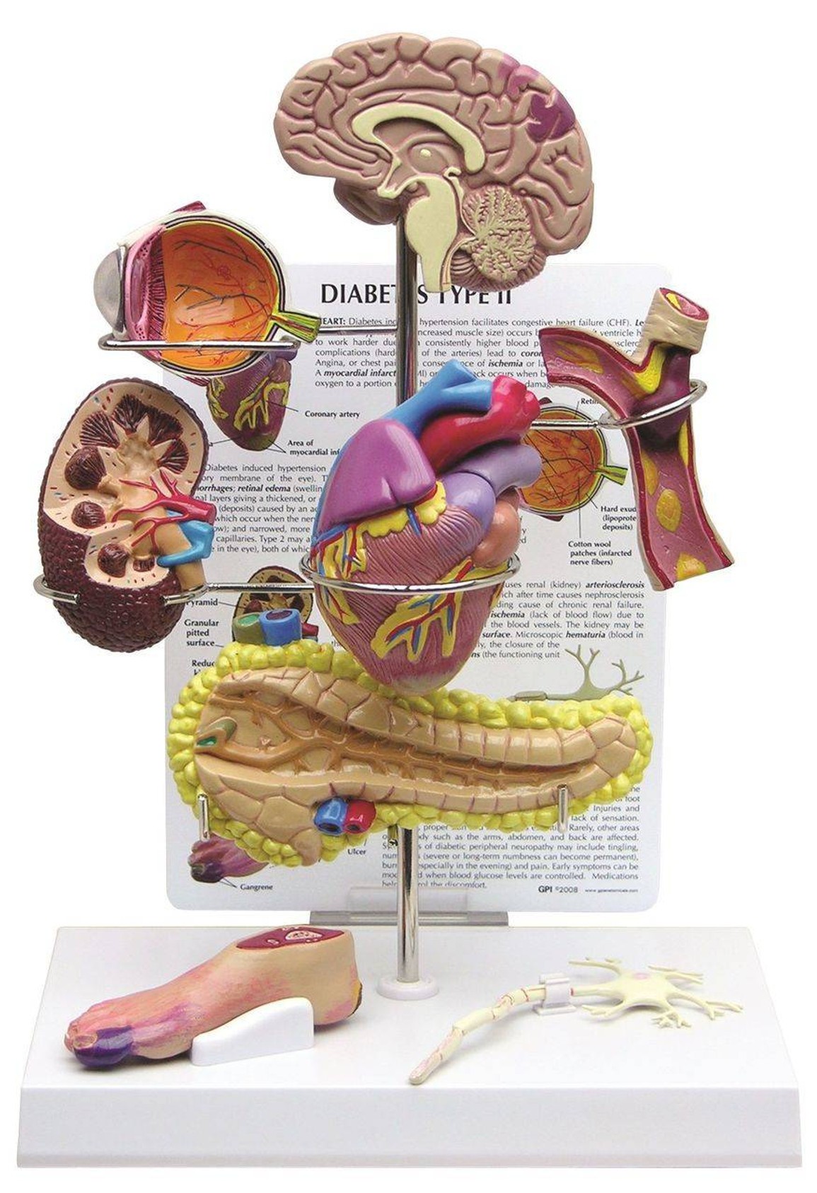 Type 2 Diabetes Anatomy Model