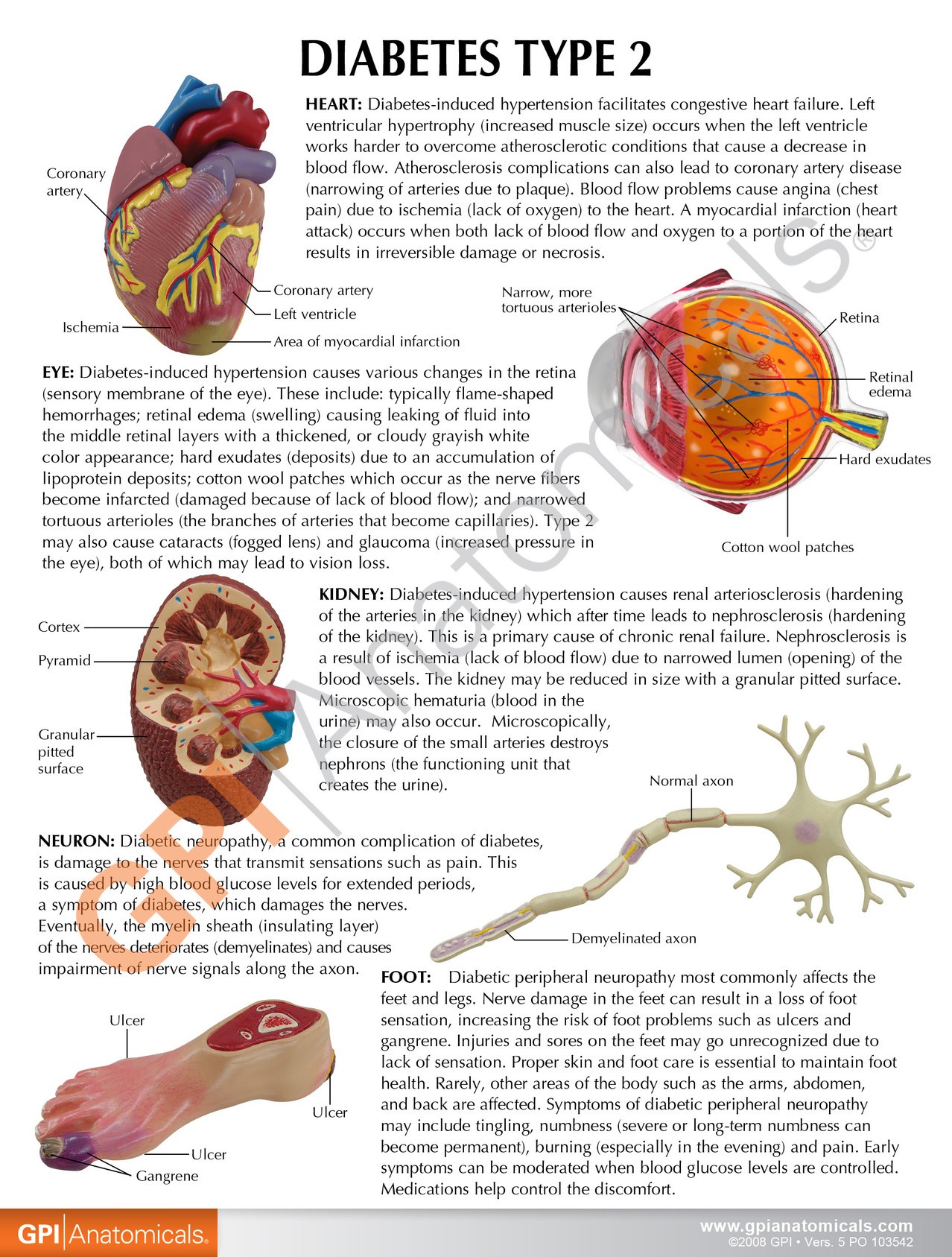 Type 2 Diabetes Anatomy Model