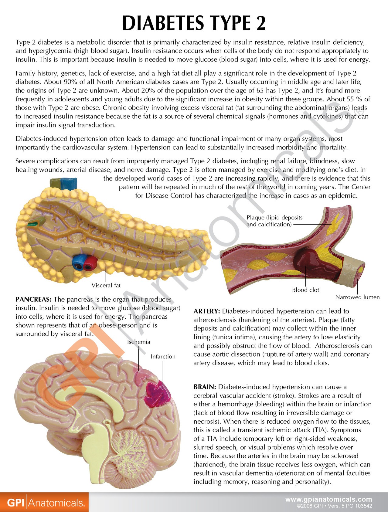 Type 2 Diabetes Anatomy Model