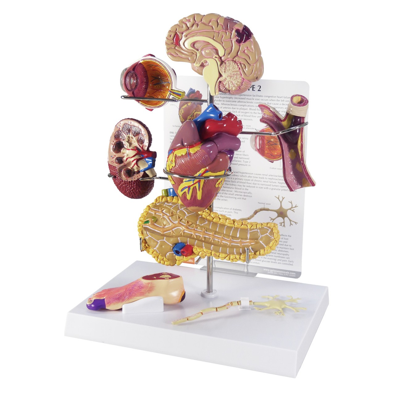 Type 2 Diabetes Anatomy Model