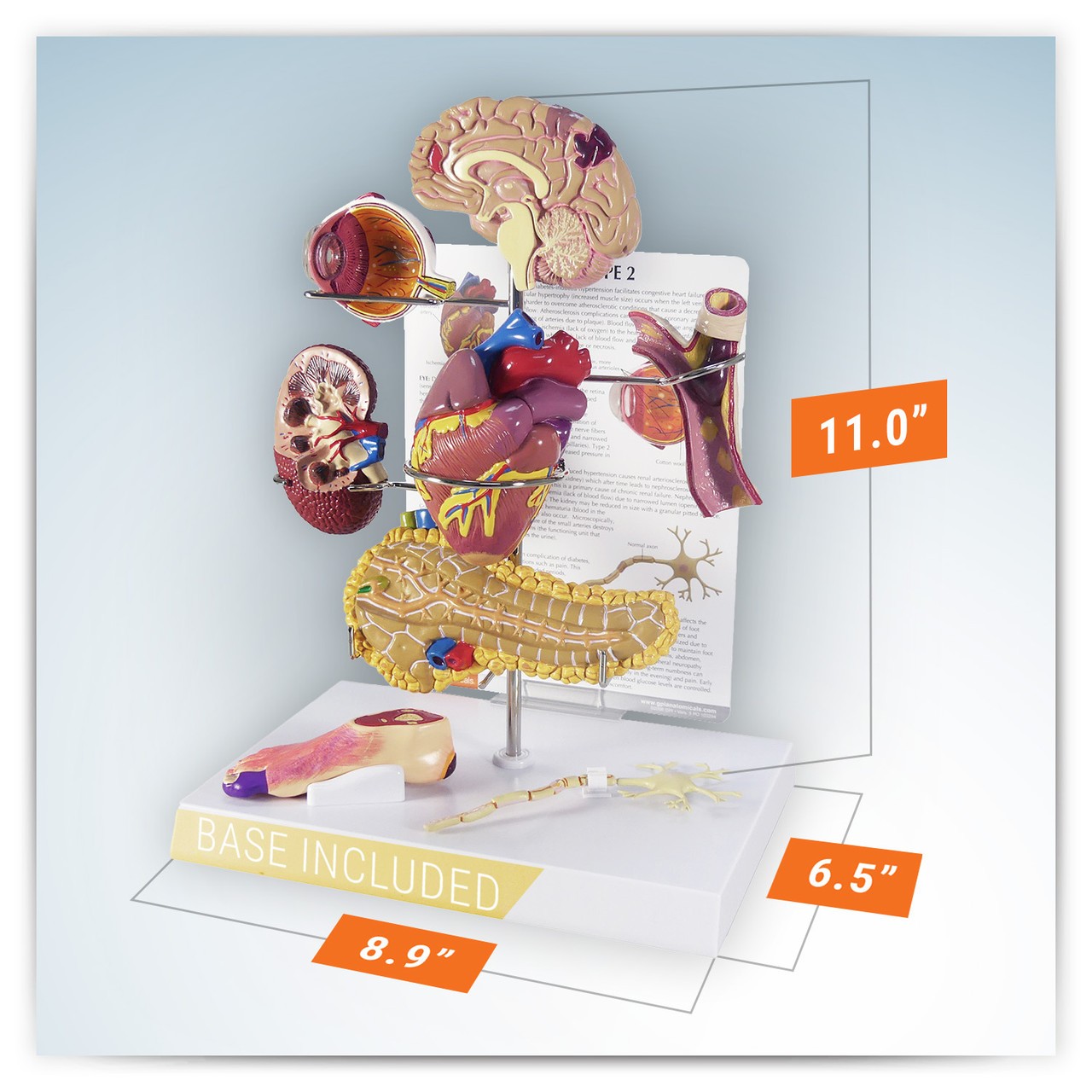 Type 2 Diabetes Anatomy Model