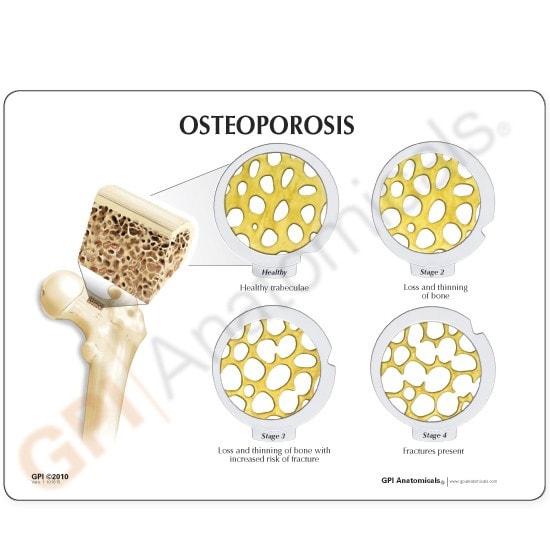 4-Stage Osteoporosis Anatomy Model