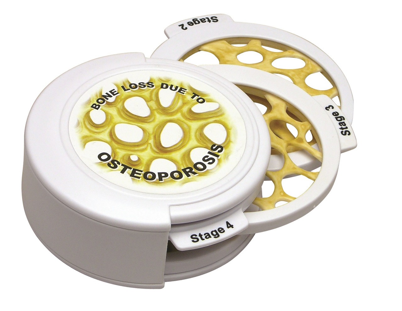 4-Stage Osteoporosis Anatomy Model