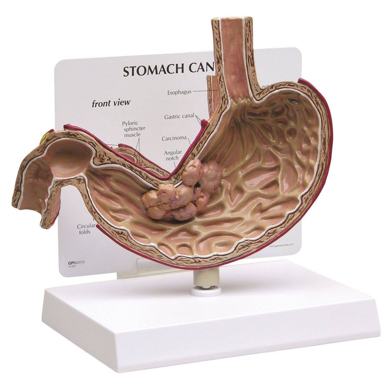 Stomach Cancer Anatomy Model