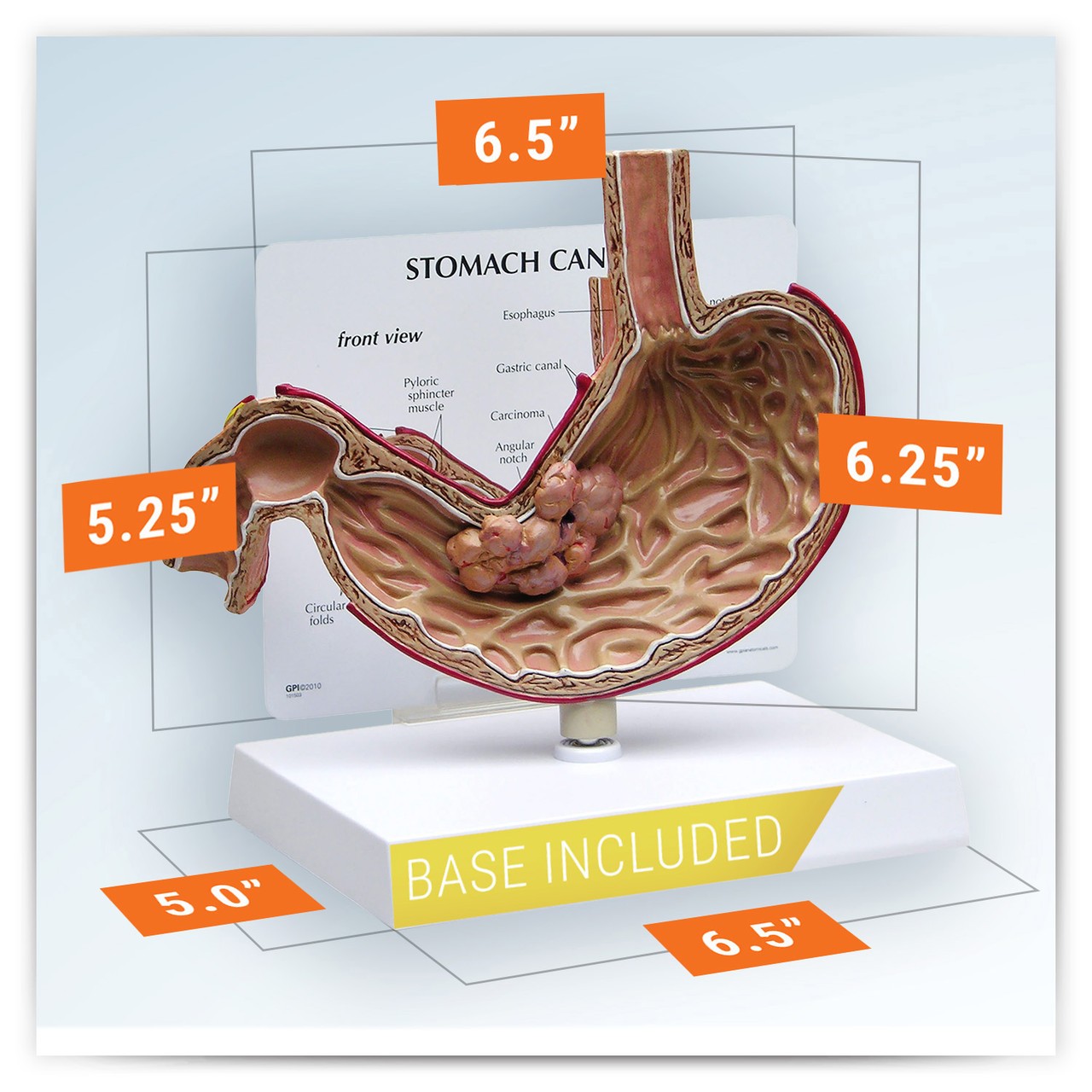 Stomach Cancer Anatomy Model