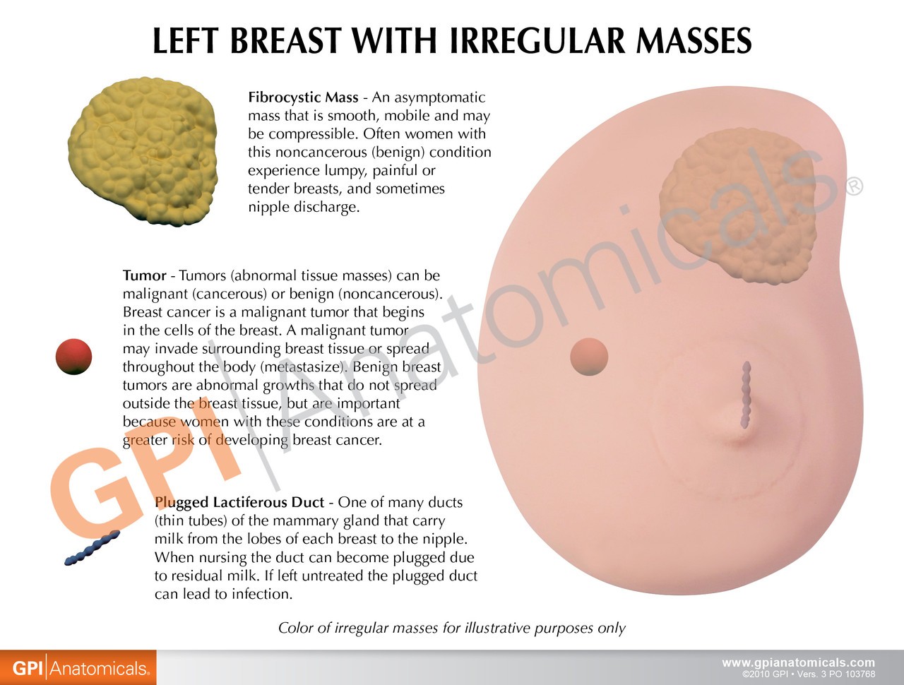 Left Breast Anatomy Model - Soft Tissue With 3 Pathologies