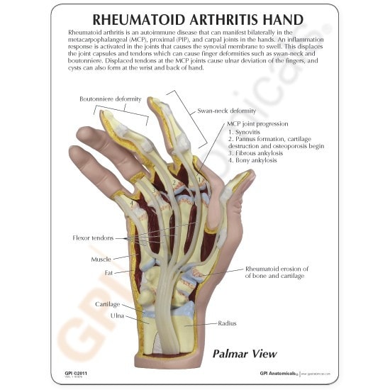 Rheumatoid Arthritis Hand Anatomy Model