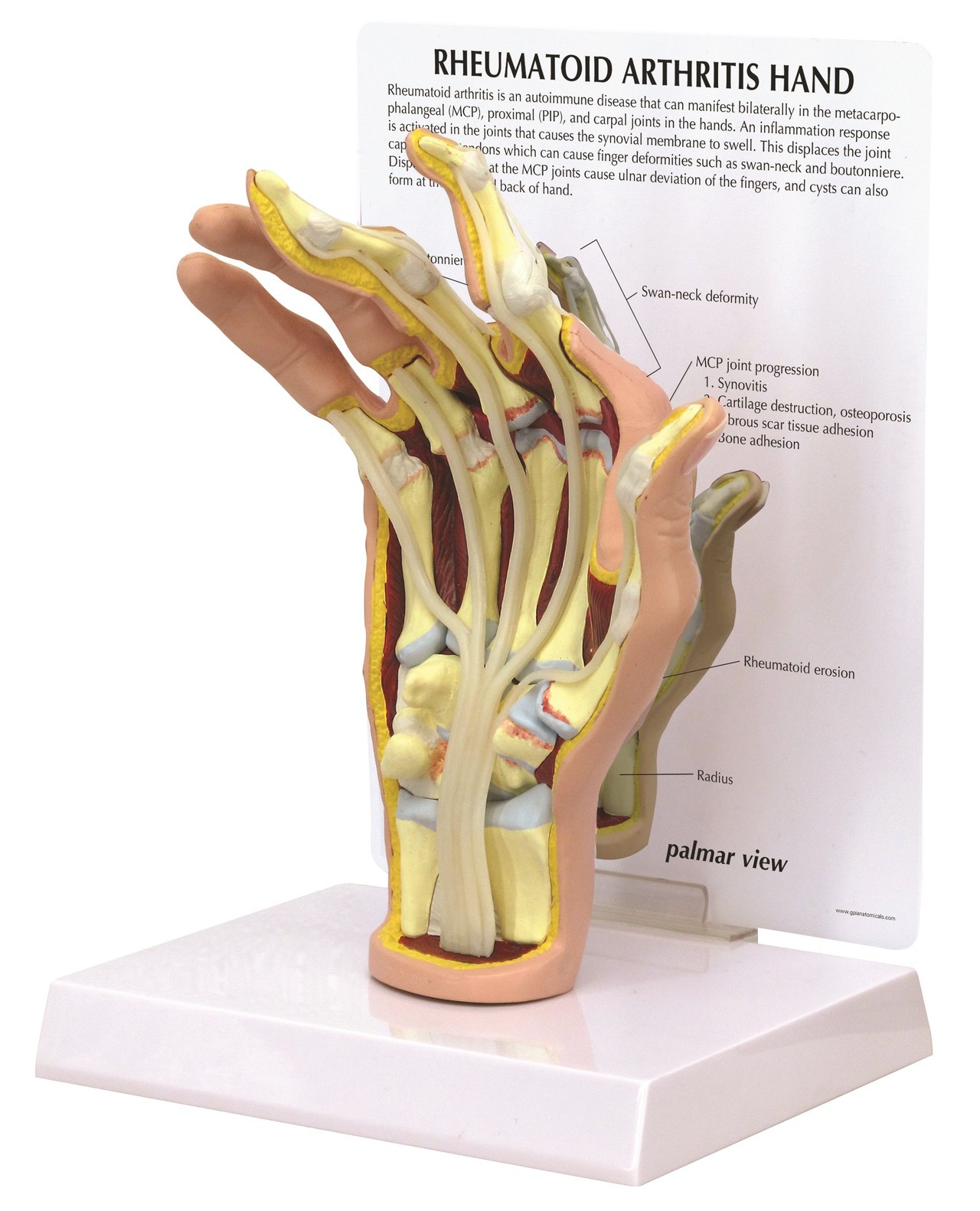 Rheumatoid Arthritis Hand Anatomy Model