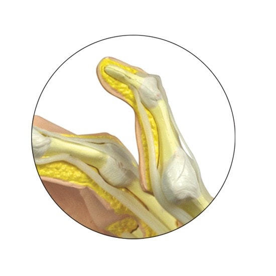 Rheumatoid Arthritis Hand Anatomy Model