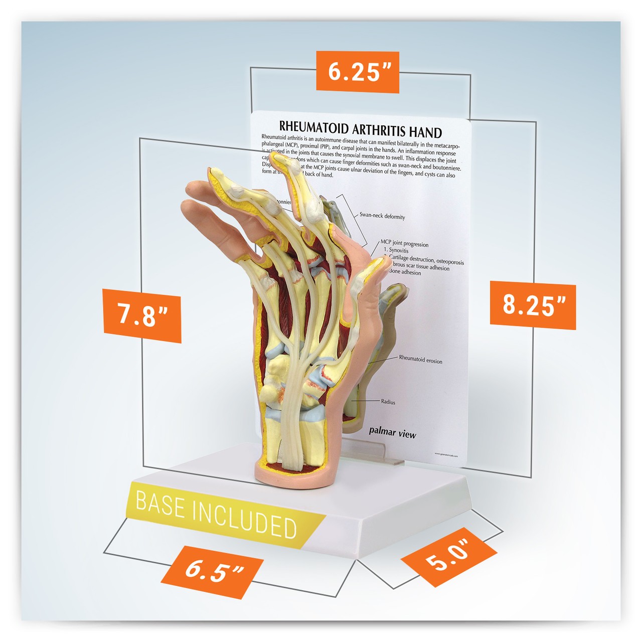 Rheumatoid Arthritis Hand Anatomy Model