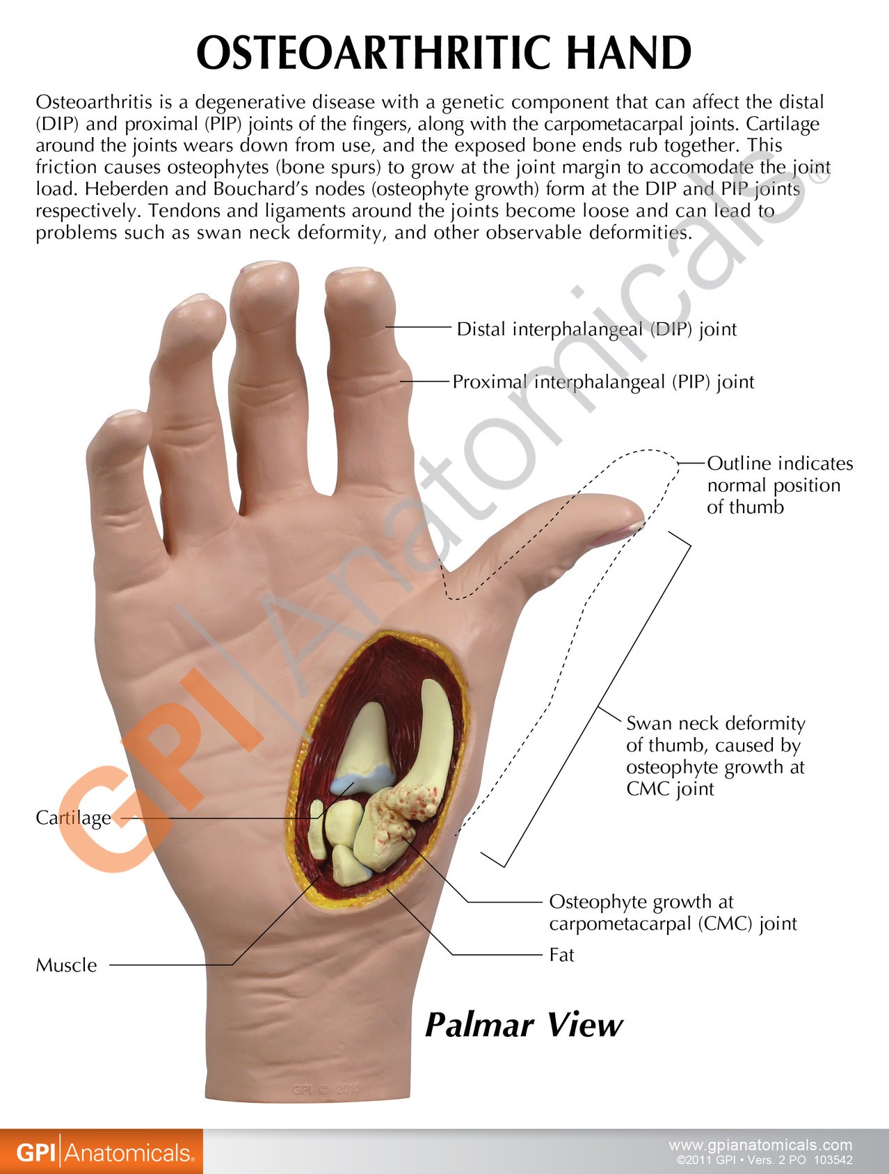 Osteoarthritis Hand Anatomy Model - education cards