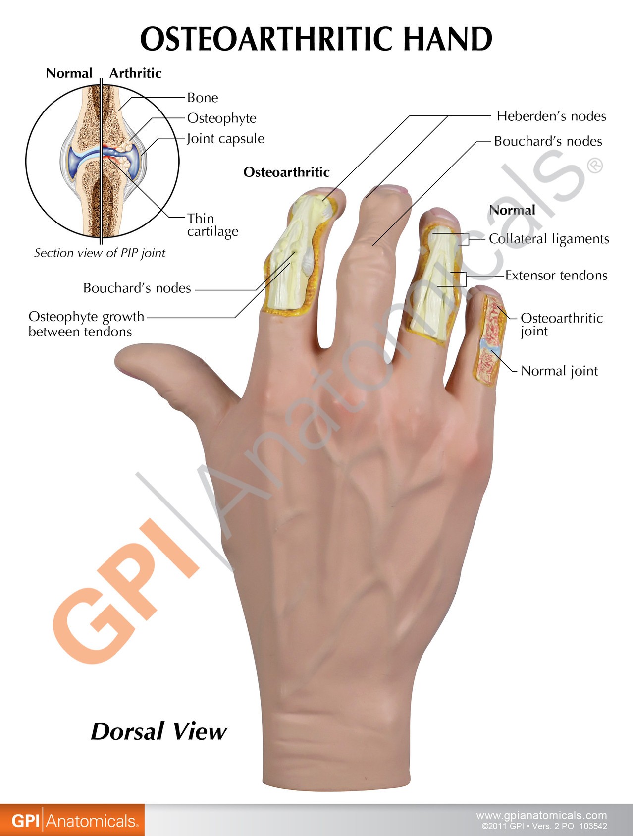 Osteoarthritis Hand Anatomy Model - education cards