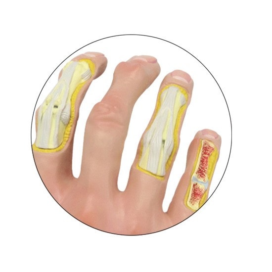 Osteoarthritis Hand Anatomy Model