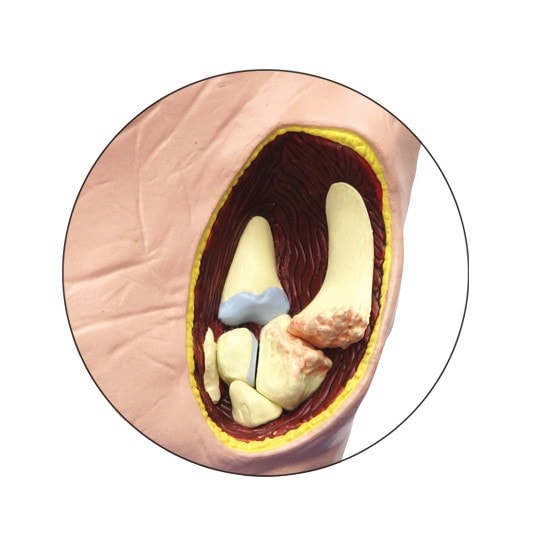 Osteoarthritis Hand Anatomy Model