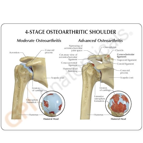 4-Stage Osteoarthritis Shoulder Anatomy Model - education cards