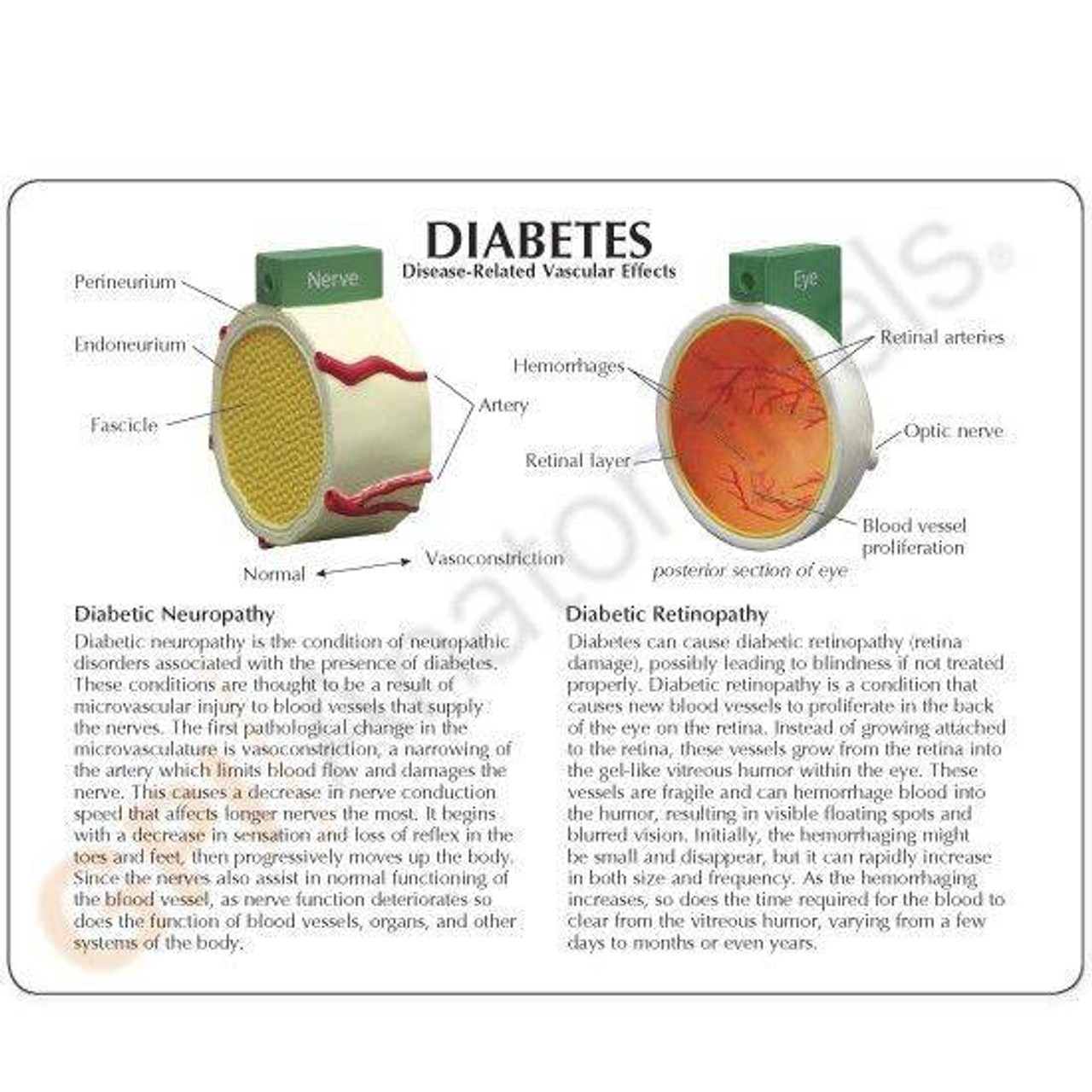 4-Piece Diabetes Anatomy Model