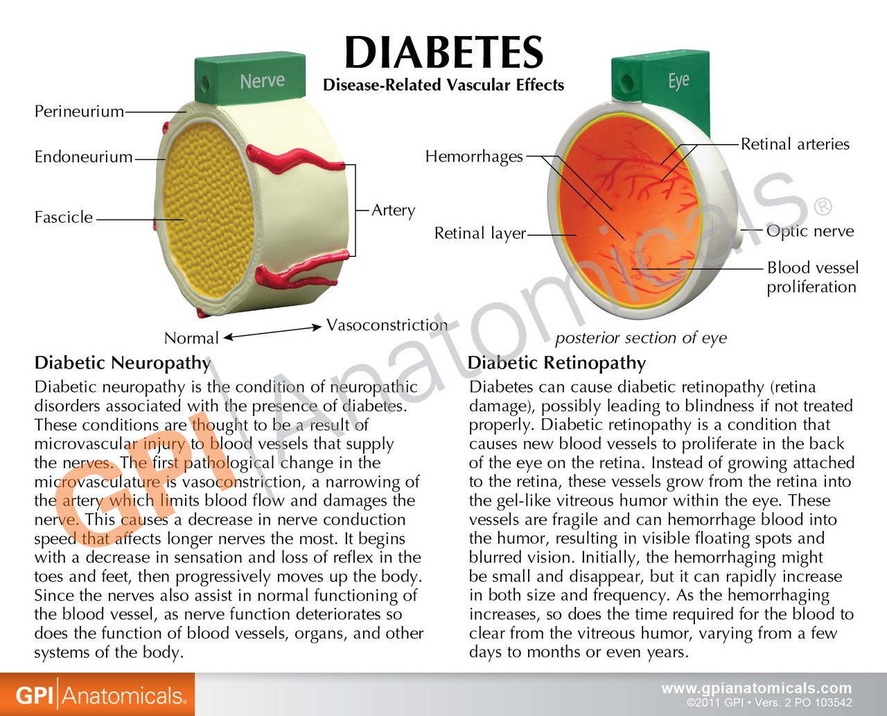 4-Piece Diabetes Anatomy Model