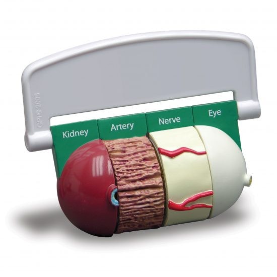 4-Piece Diabetes Anatomy Model