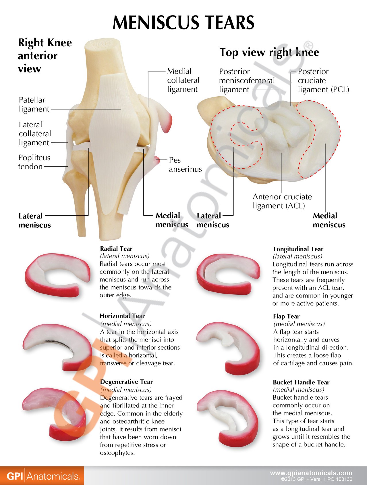 Knee with Meniscus Tears - front
