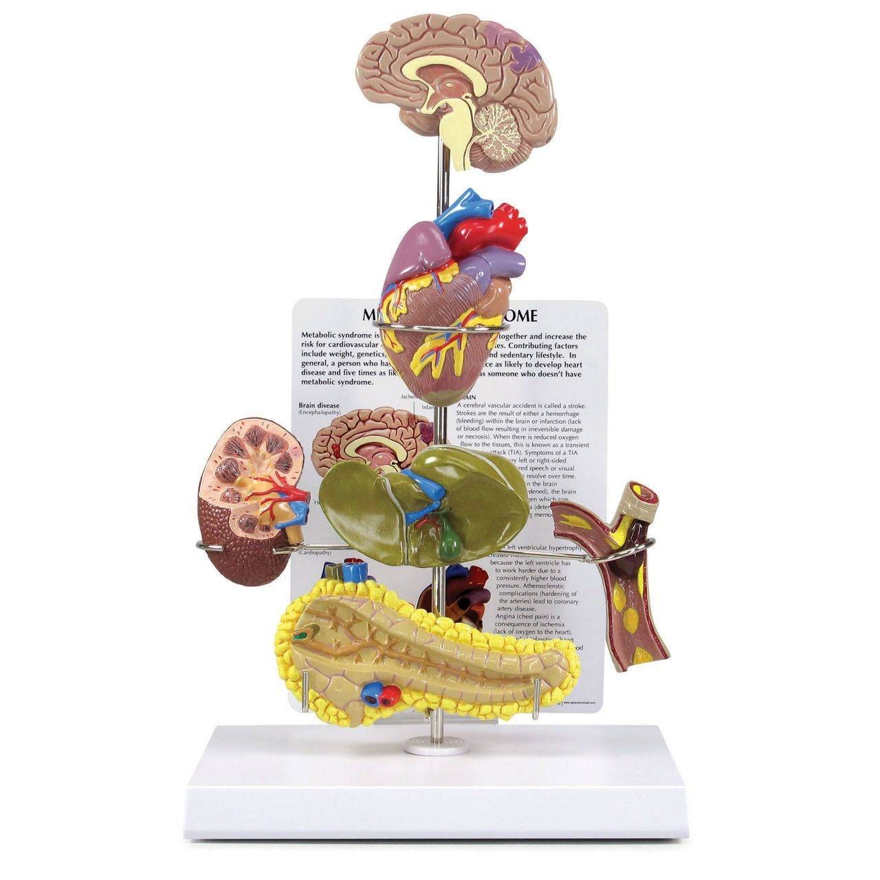 Metabolic Syndrome Anatomy Model Set