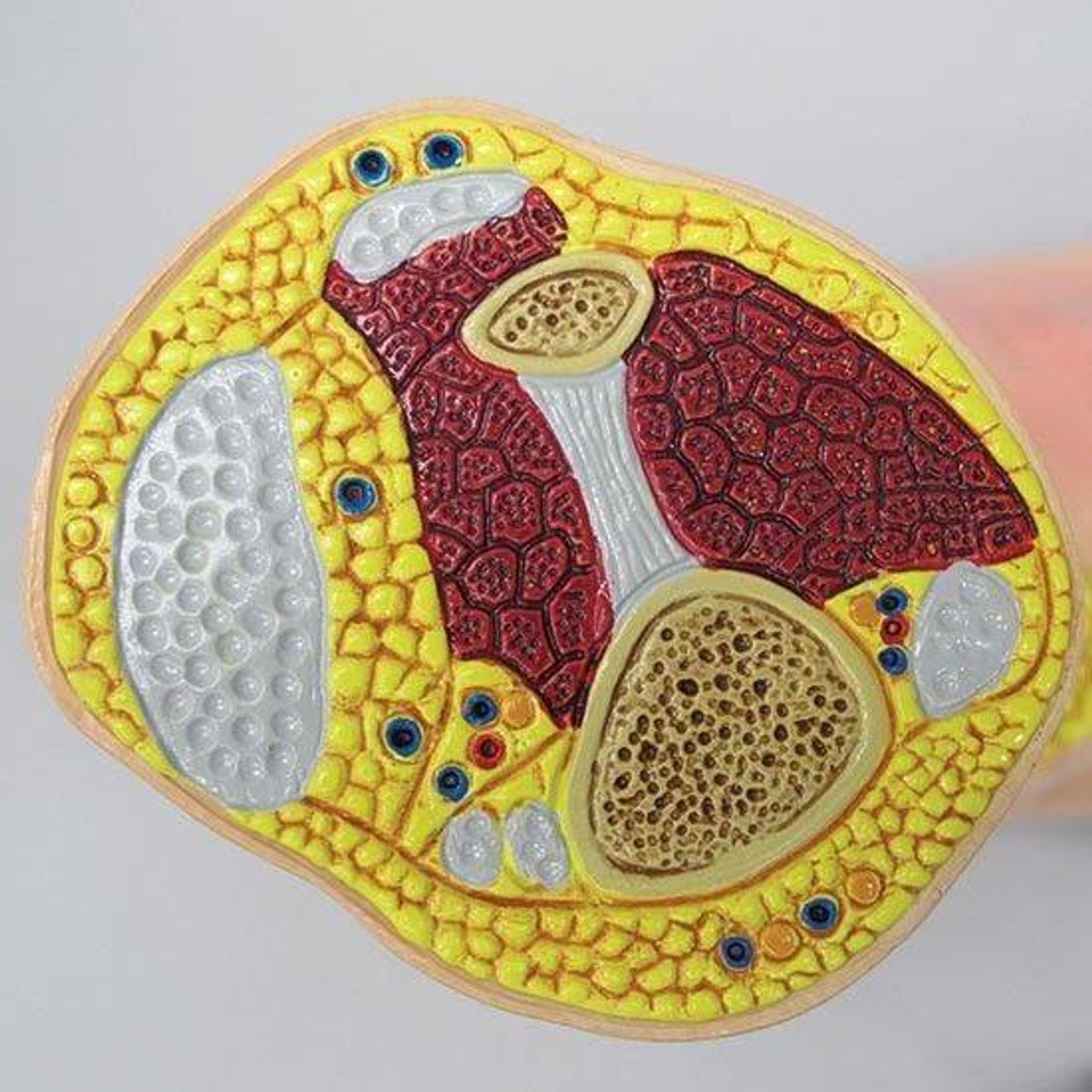 Foot with Gout Anatomy Model