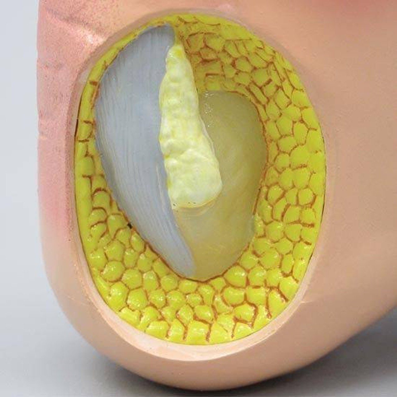 Foot with Gout Anatomy Model