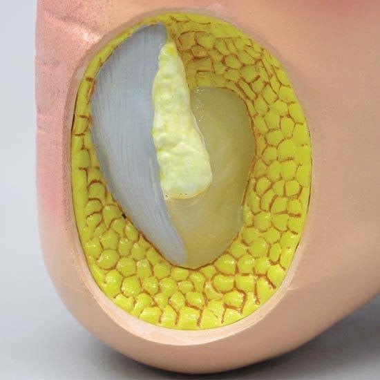 Foot with Gout Anatomy Model