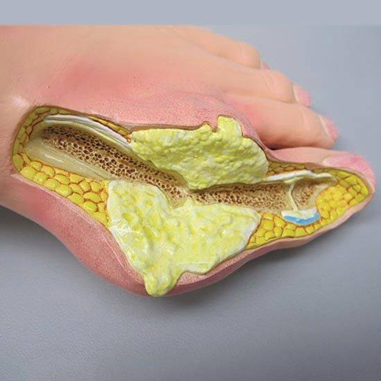 Foot with Gout Anatomy Model
