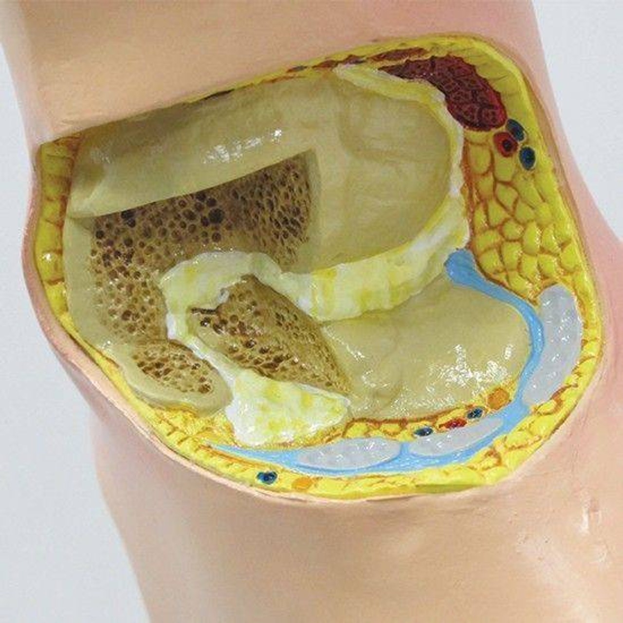 Foot with Gout Anatomy Model