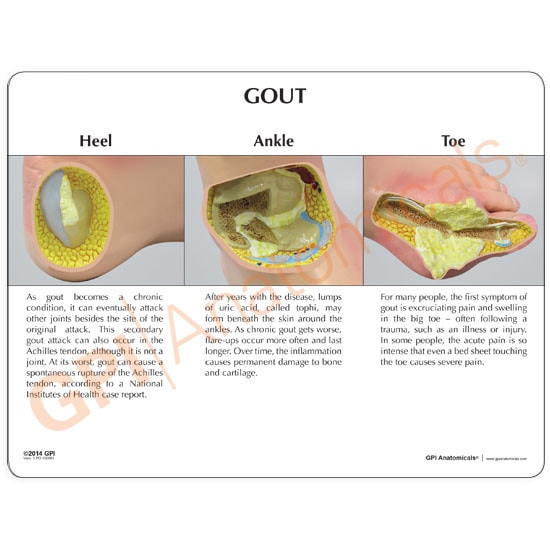 Foot with Gout Anatomy Model - back