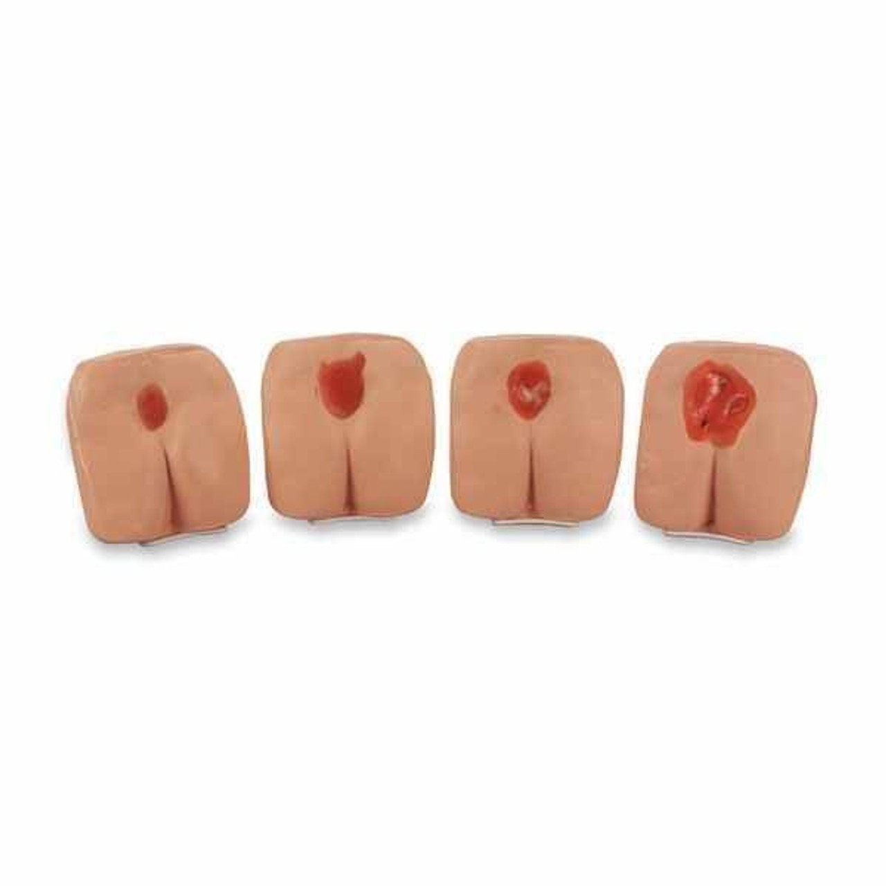 4-Stages Pressure Ulcer/Bedsore Model Set Of 4