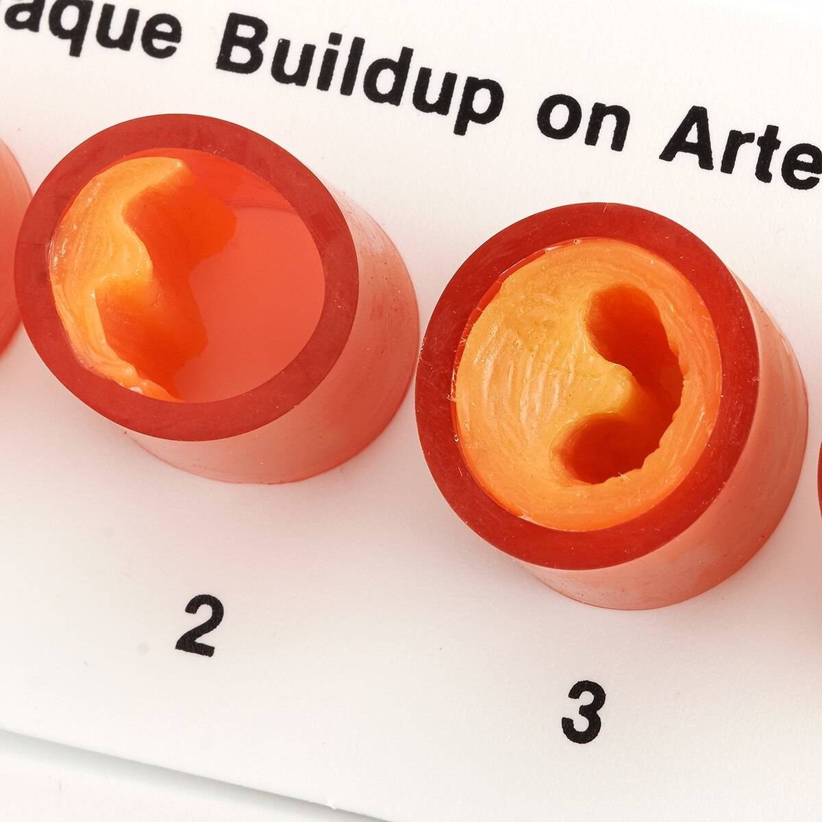 Nasco Healthcare Artery Section with Blockage Model | Anatomy