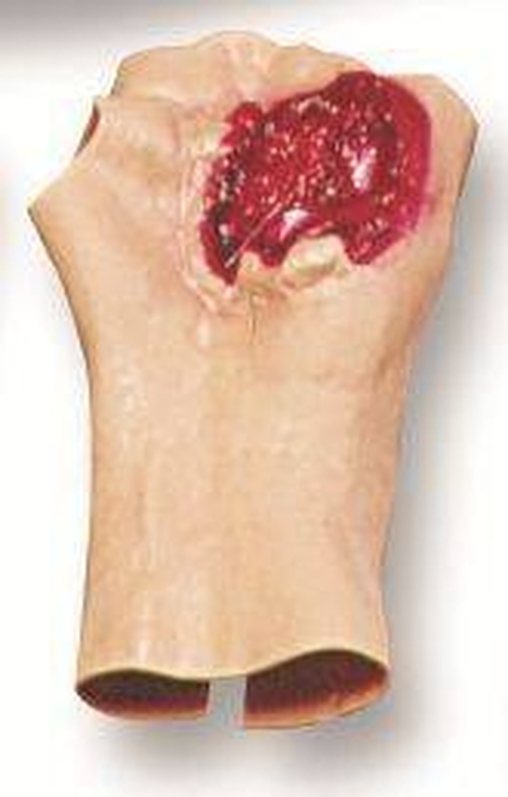 Gunshot Wound Of The Palm Model