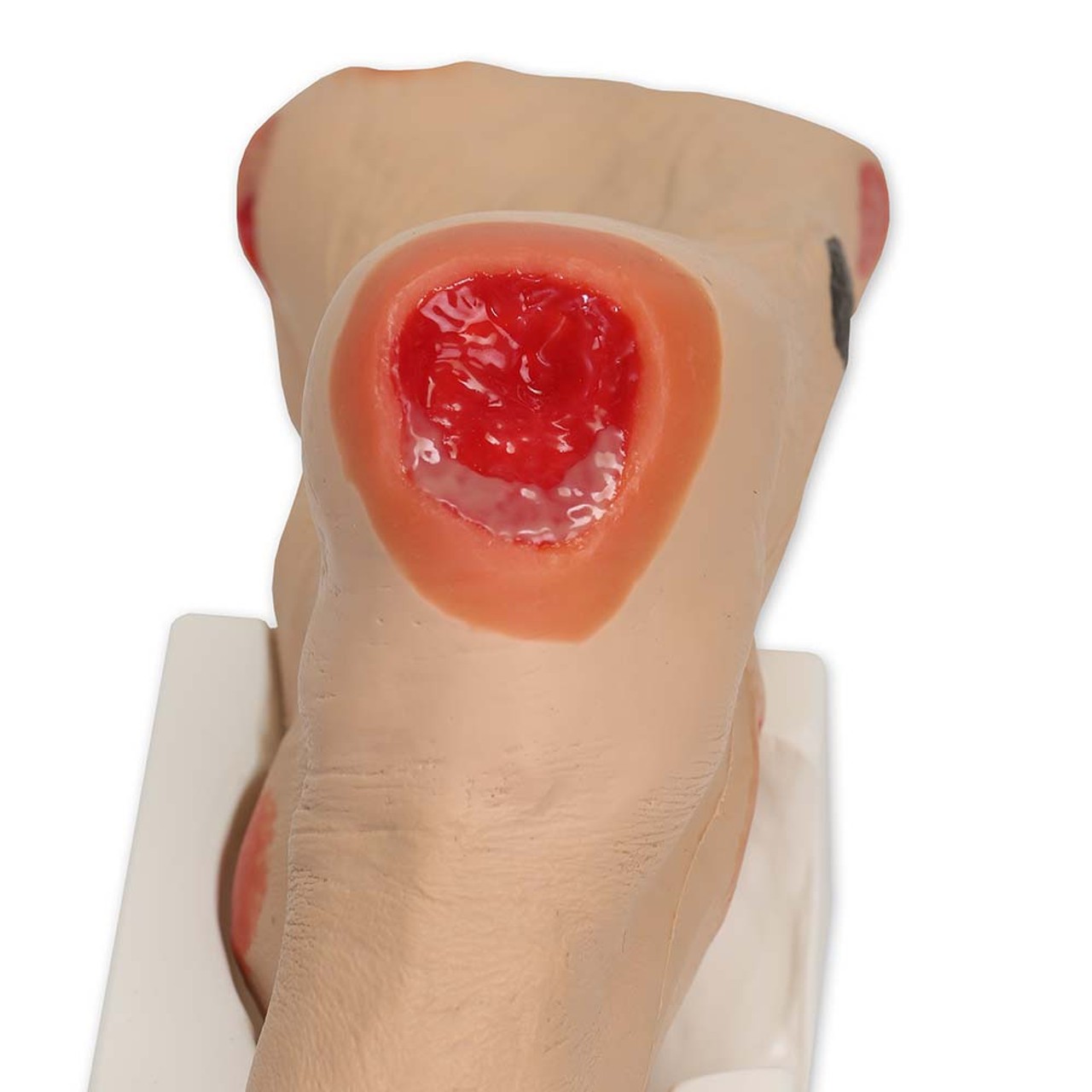 Wilma Wound Foot