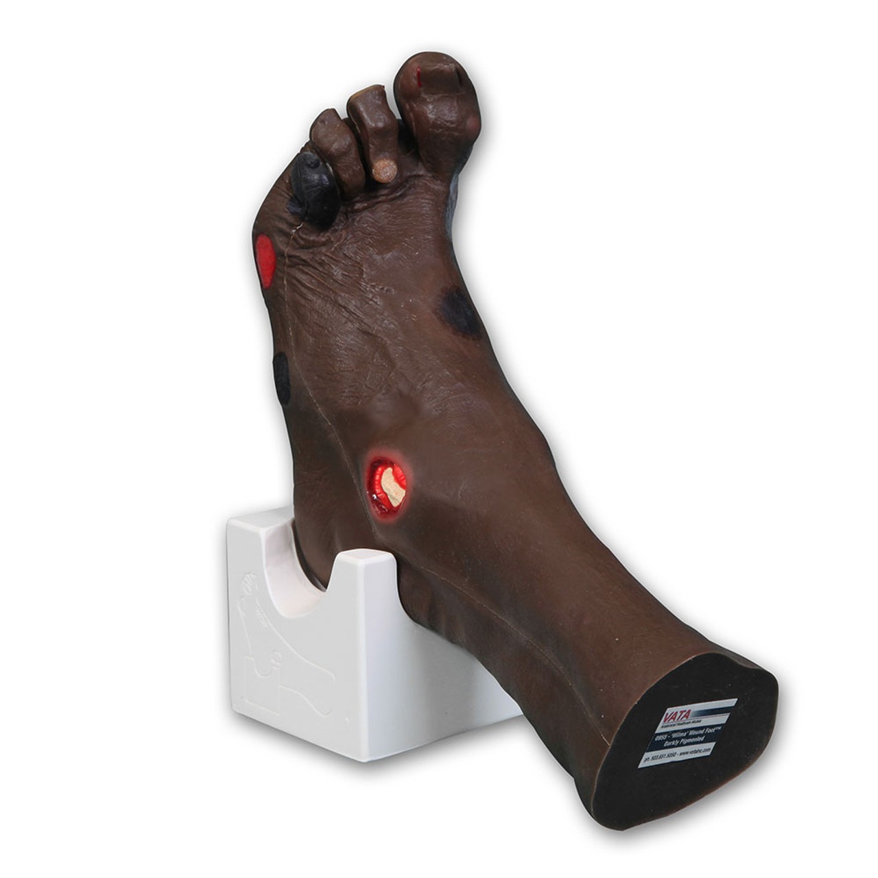 Wilma Wound Foot, Darkly Pigmented