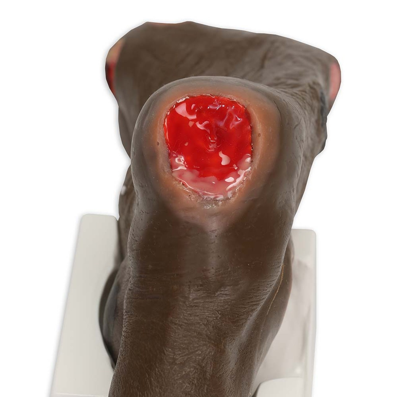 Wilma Wound Foot, Darkly Pigmented