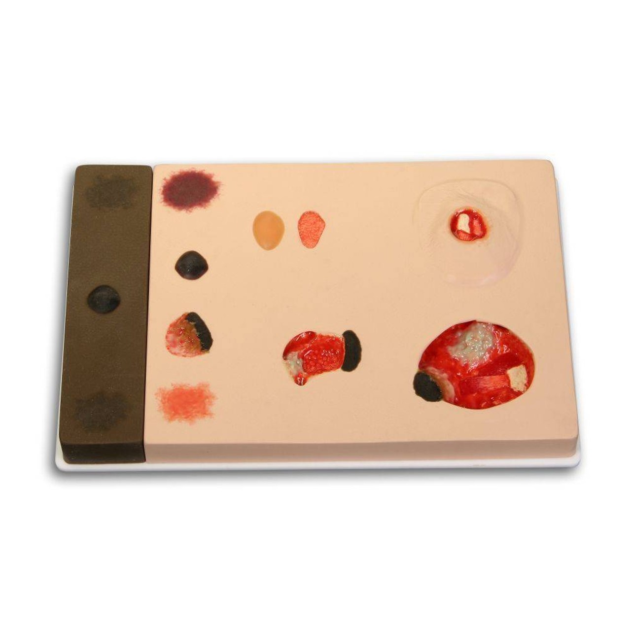 Pat Pressure Injury Staging Model